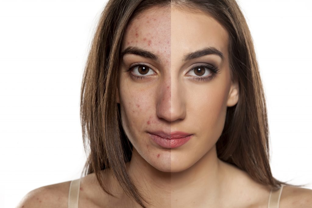 dermatologist pimples